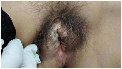 Efficacy of dupilumab in the treatment of severe vulvar pruritus associated with lichen sclerosus et atrophicus: a case report